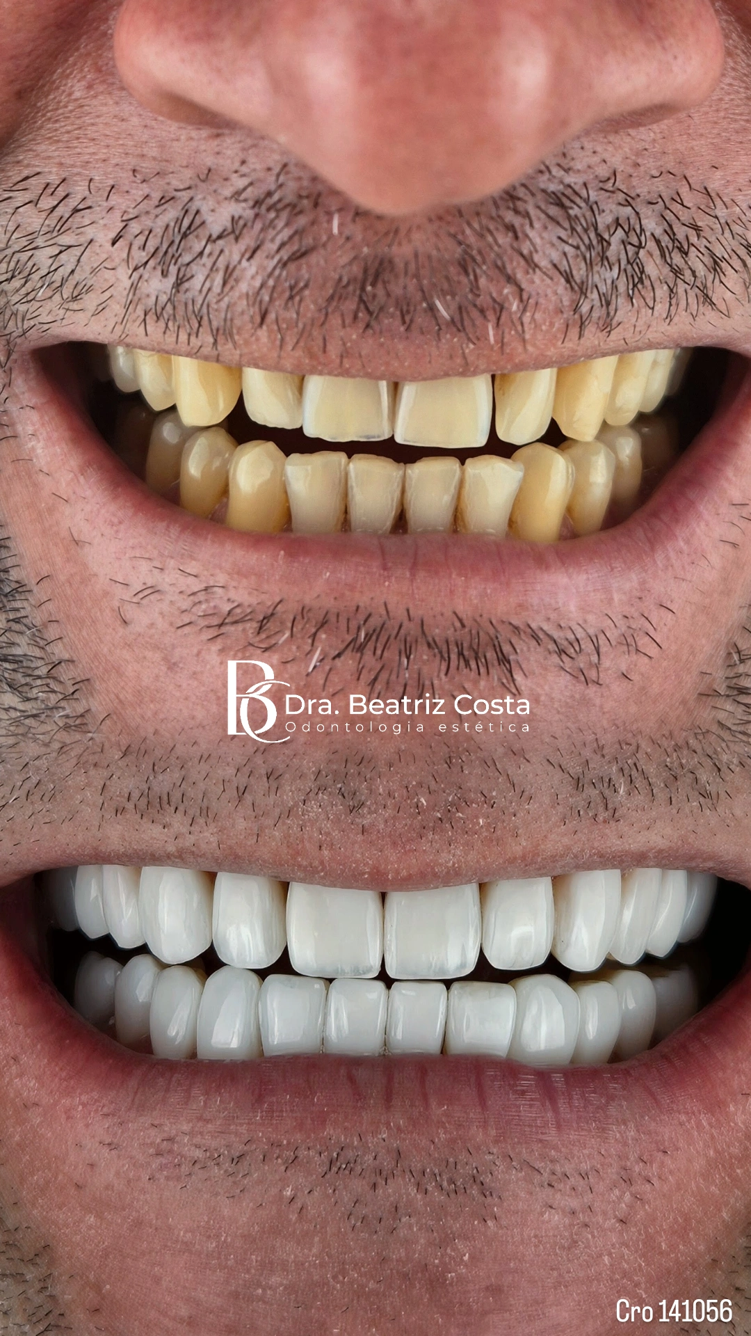Sorriso antes e depois — clareamento e reabilitação