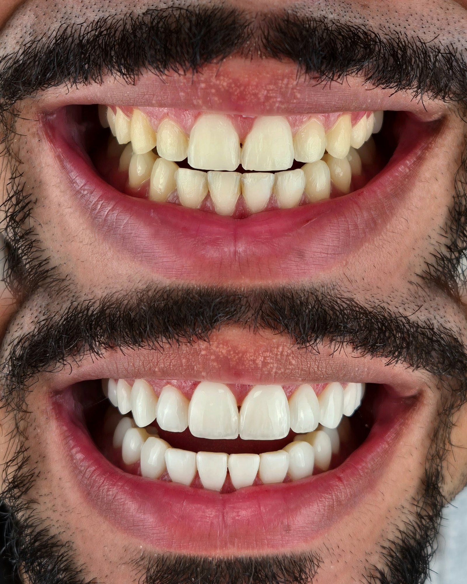 Sorriso antes e depois — facetas de resina e formato